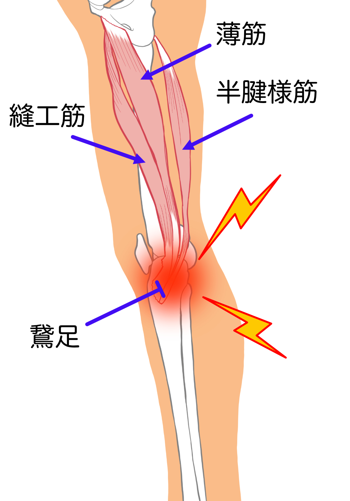 鵞足炎